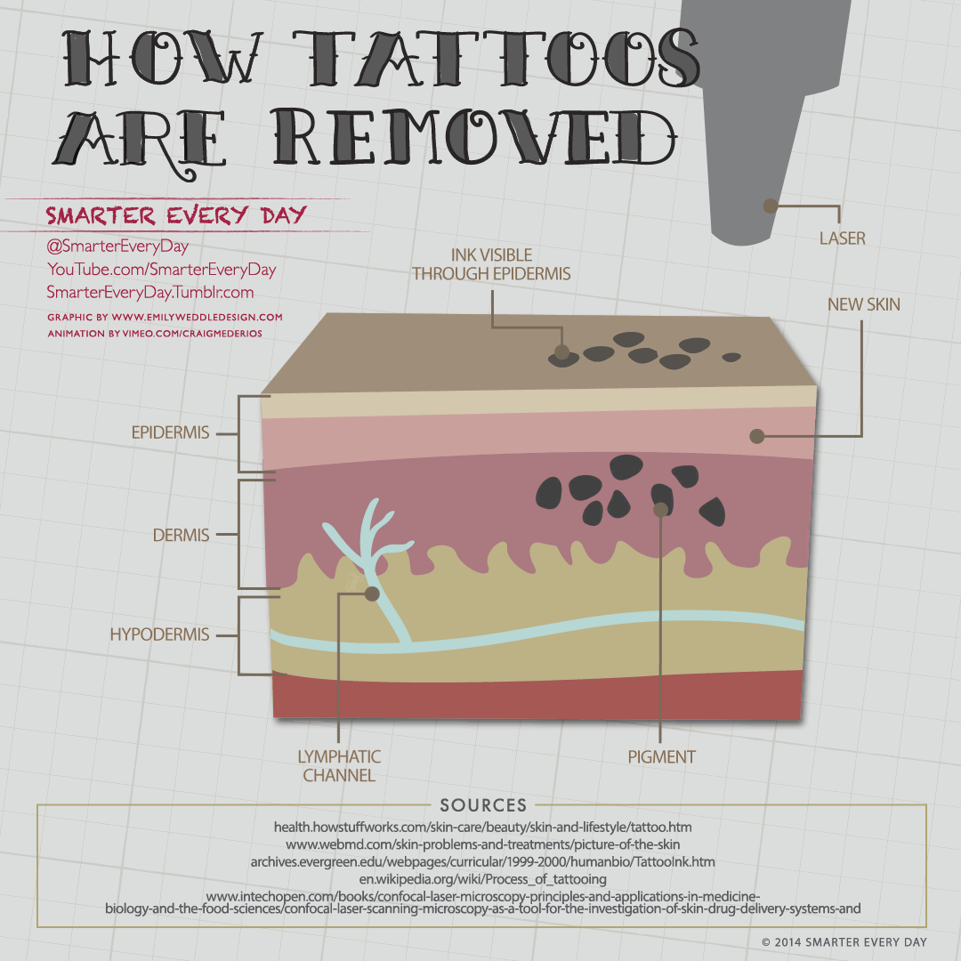 tattoo removal process
