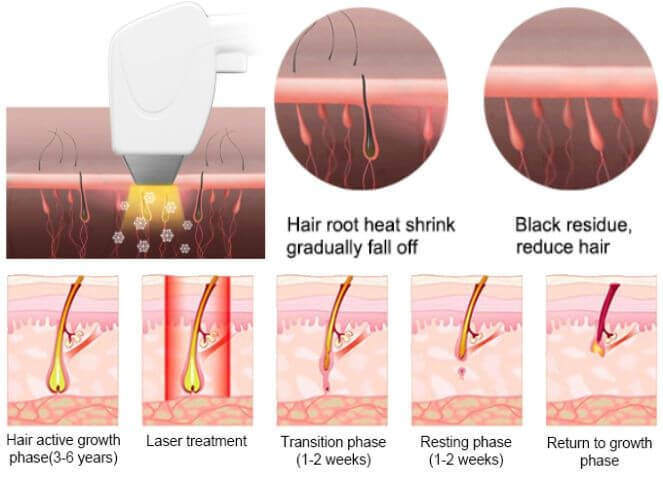 hair removal process