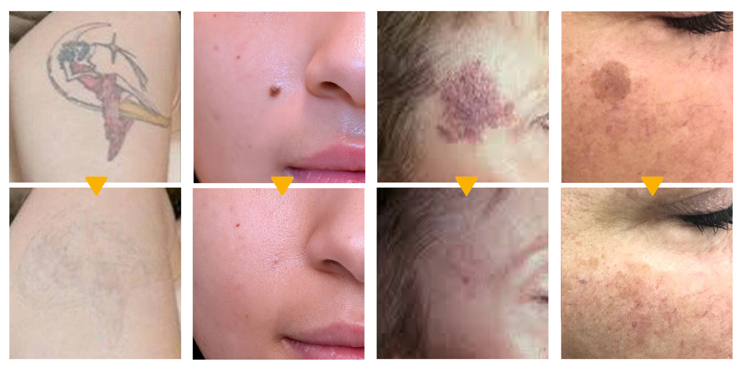 Before and after use of tattoo removal