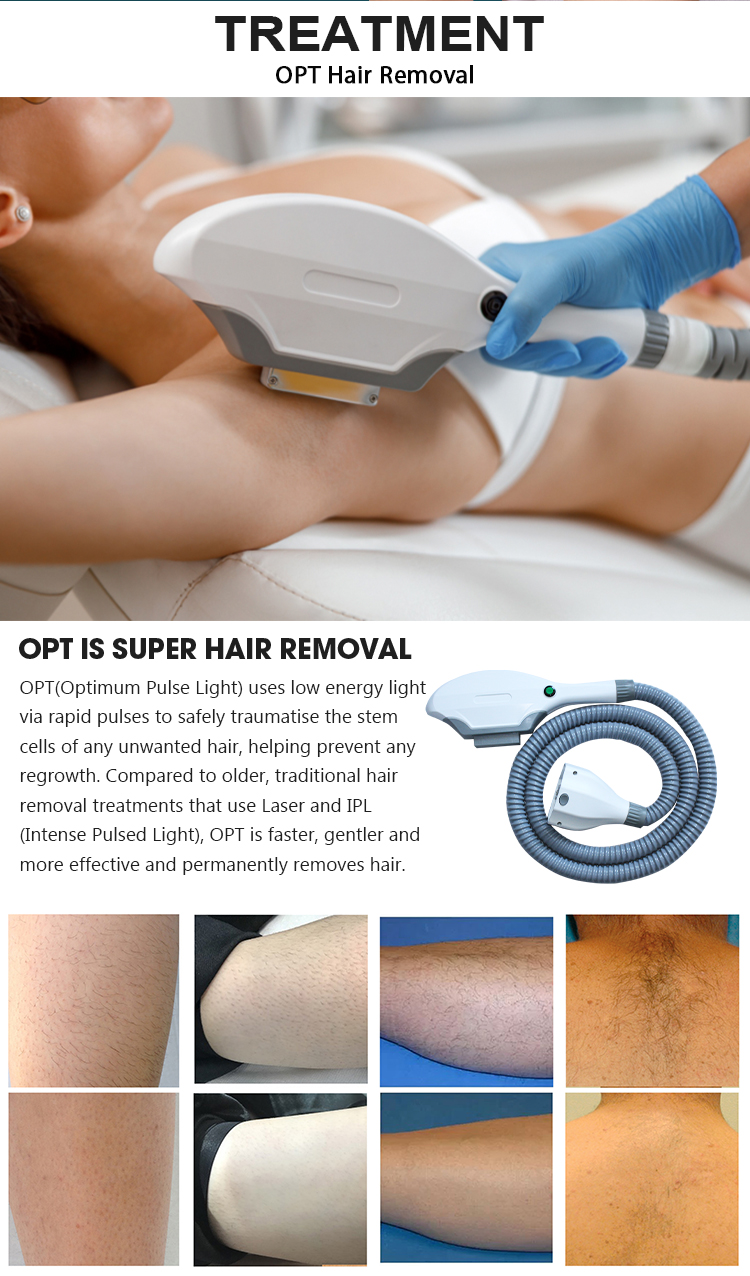 SHR Hair Removal Machine