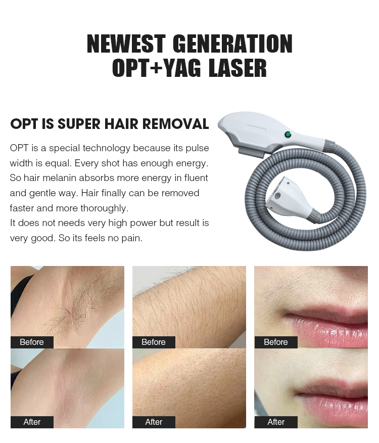 SHR YAG hair removal