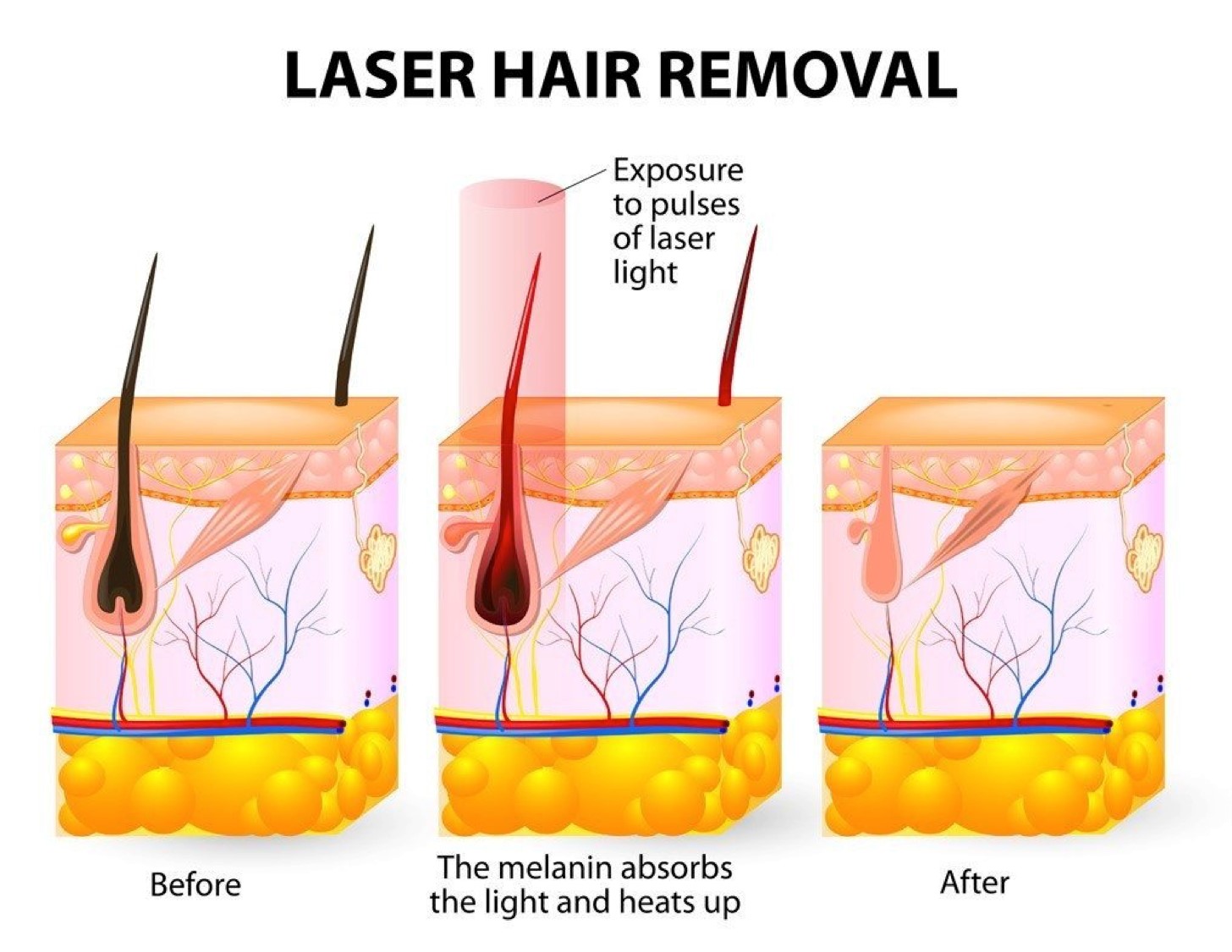 SHR YAG hair removal