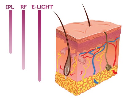 SHR IPL YAG RF Laser Hair Removal Machine