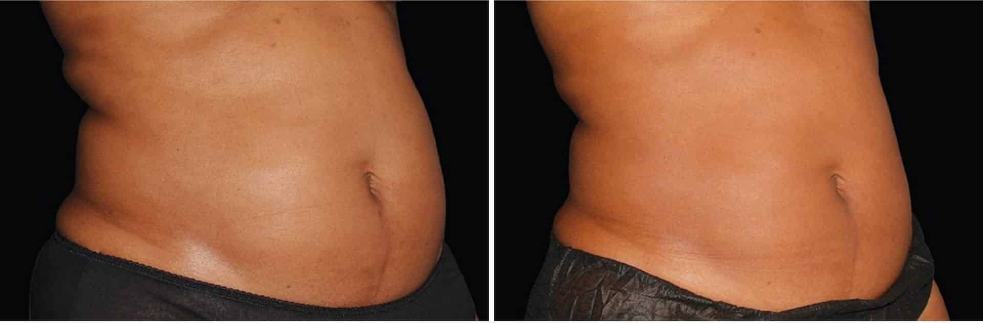 Before and after use of body slimming