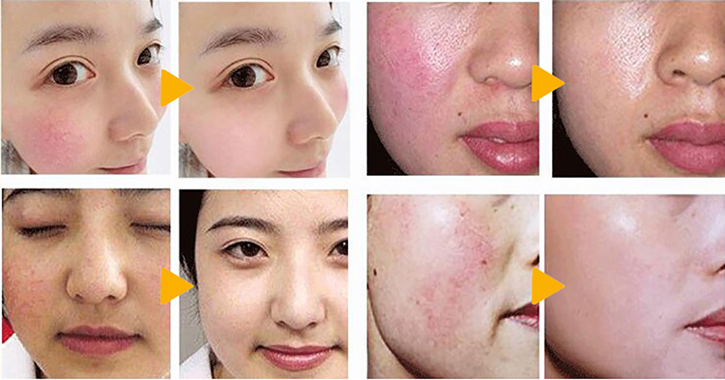 Before and after use of redness removal