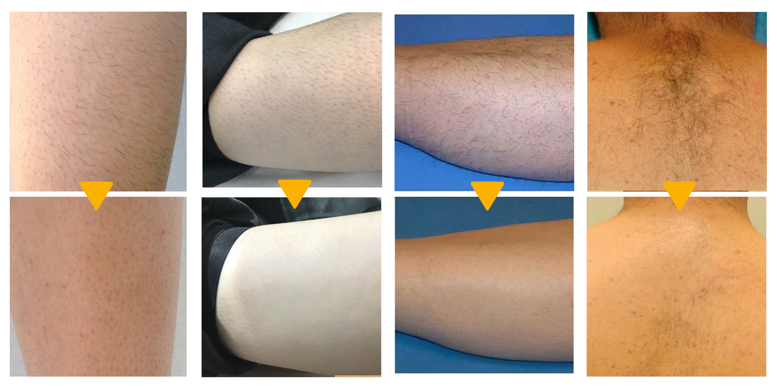 Hair removal effect comparison