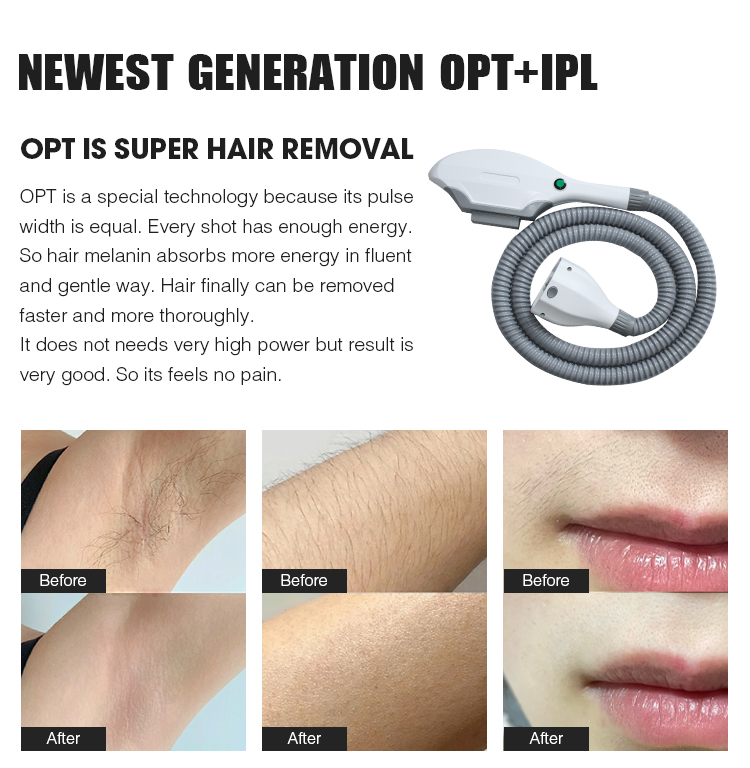 IPL SHR Hair Removal
