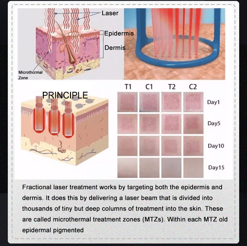 10600nm fractional co2 laser