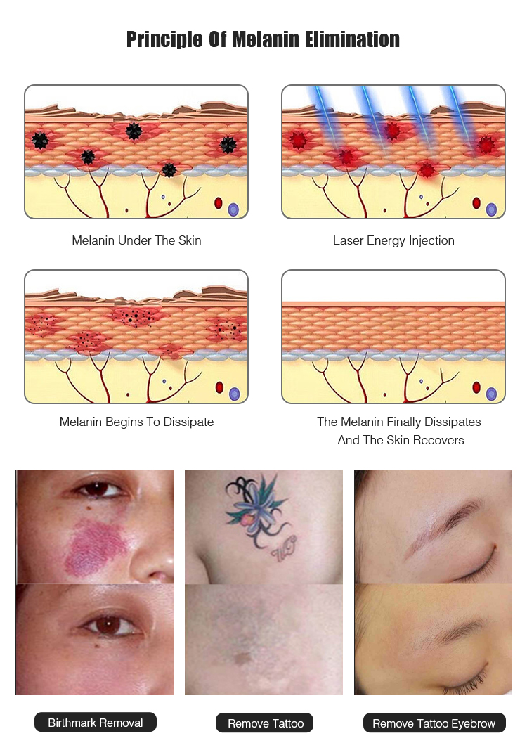 IPL SHR YAG hair removal