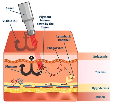 Laser Tattoo Removal