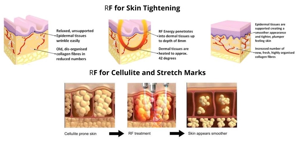 RF for skin tightening