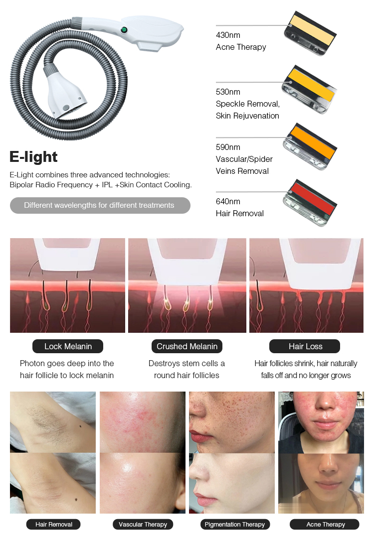 SHR IPL YAG RF Laser Hair Removal Machine