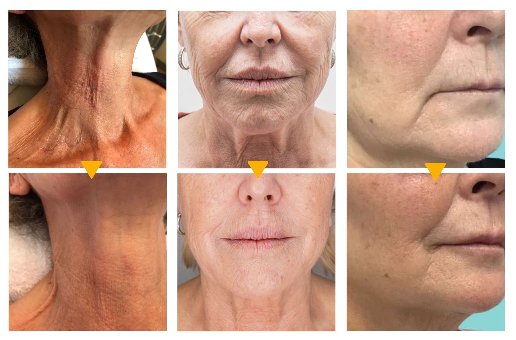 Before and after use of wrinkle removal