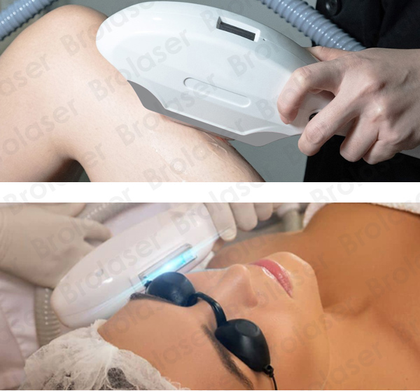 IPL SHR Hair removal machine