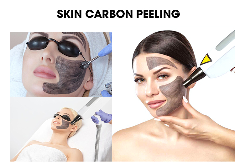 SHR YAG hair removal