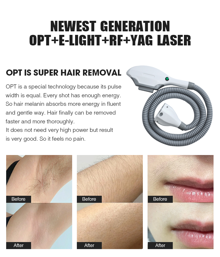 SHR IPL YAG RF Laser Hair Removal Machine