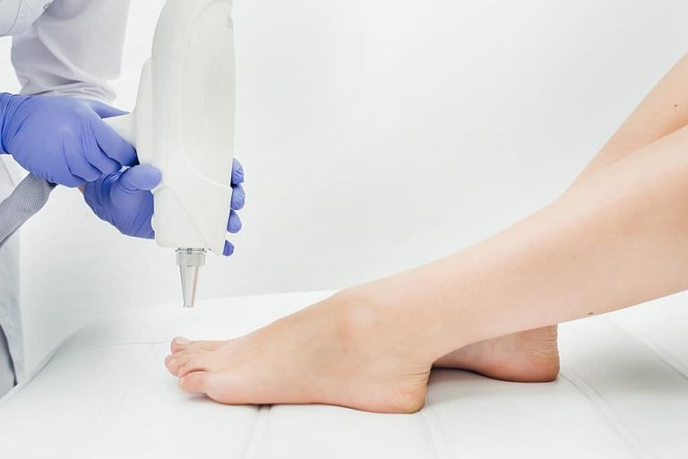 laser tattoo removal machine