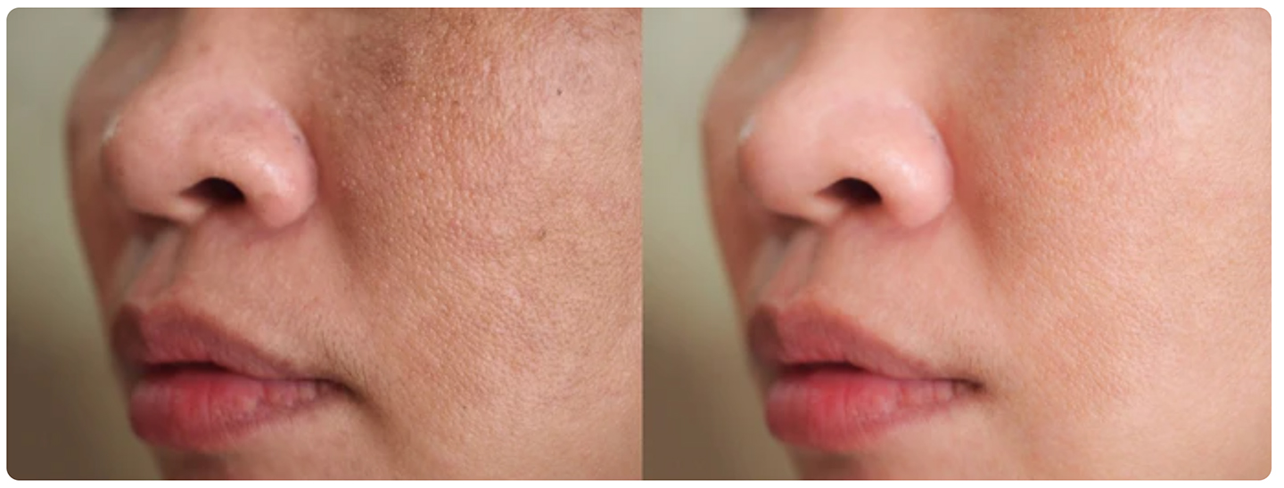 Before and after use of skin whitening and rejuvenation