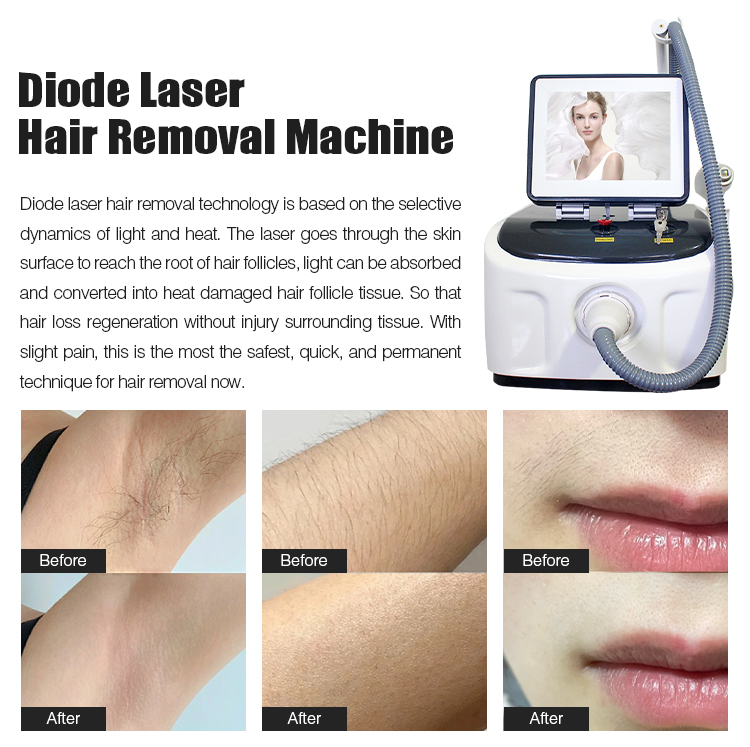 Diode Laser Hair Removal Machine