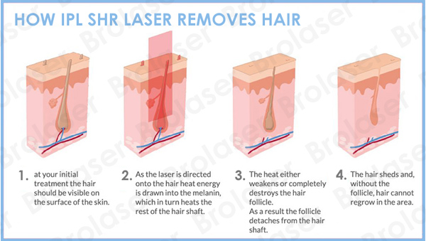 IPL SHR hair removal