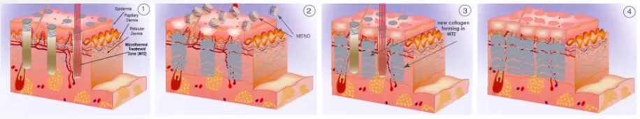 fractional-co2-laser-principle