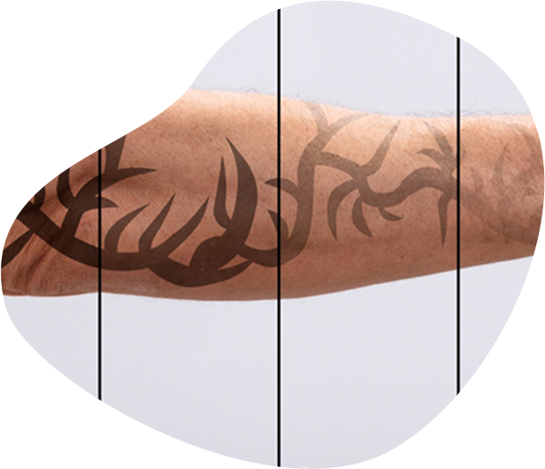 TATTOO REMOVAL