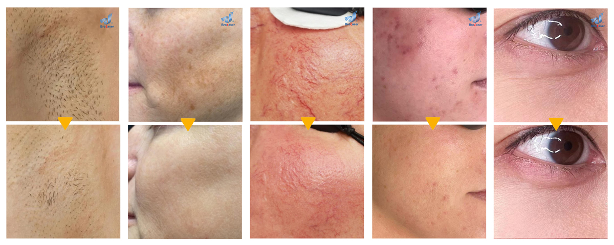 IPL SHR Hair Removal