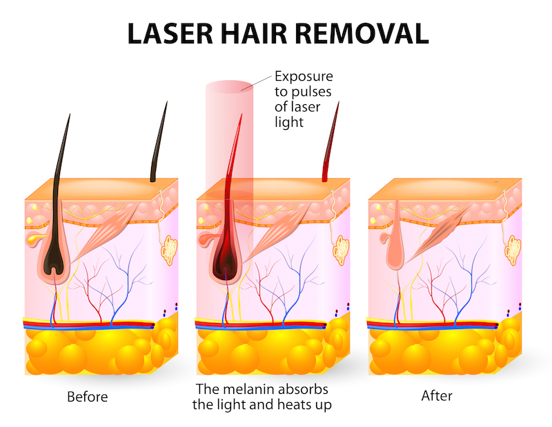 laser hair removal