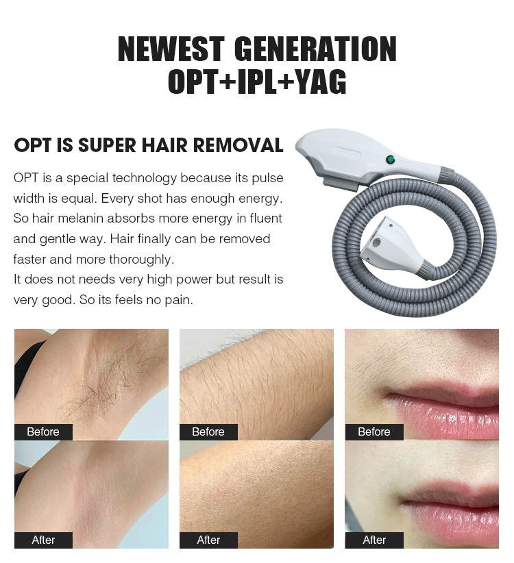 IPL SHR YAG hair removal