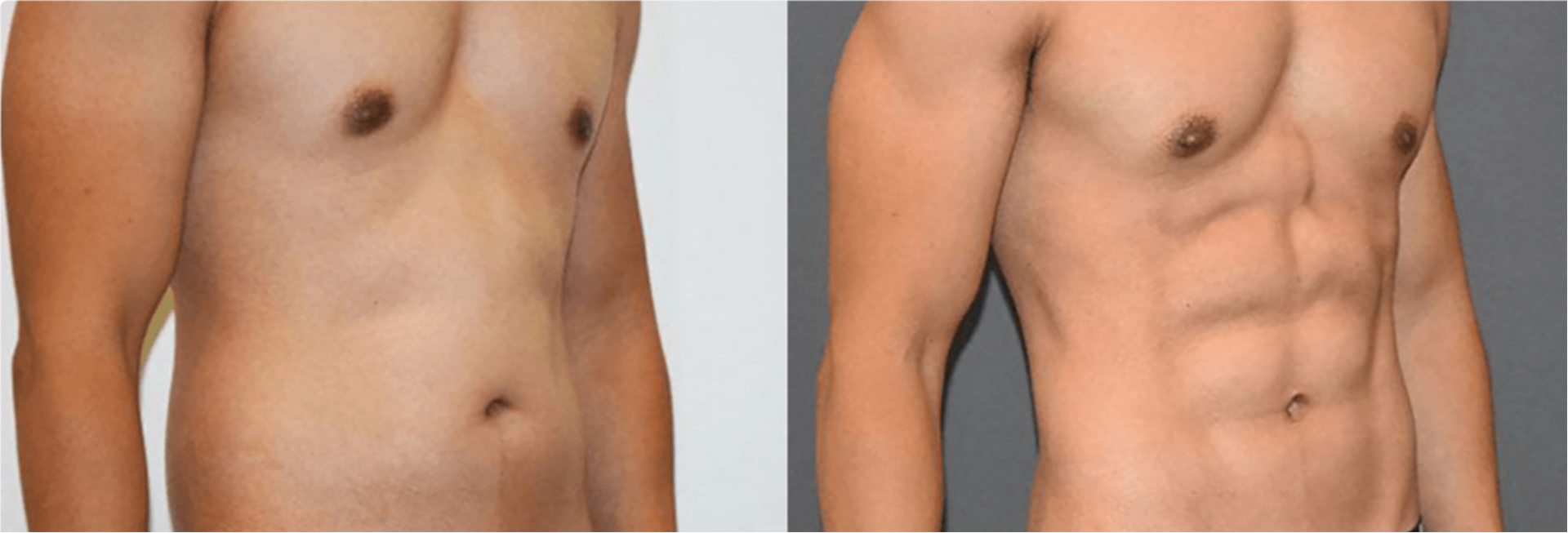 Before and after use of body shaping